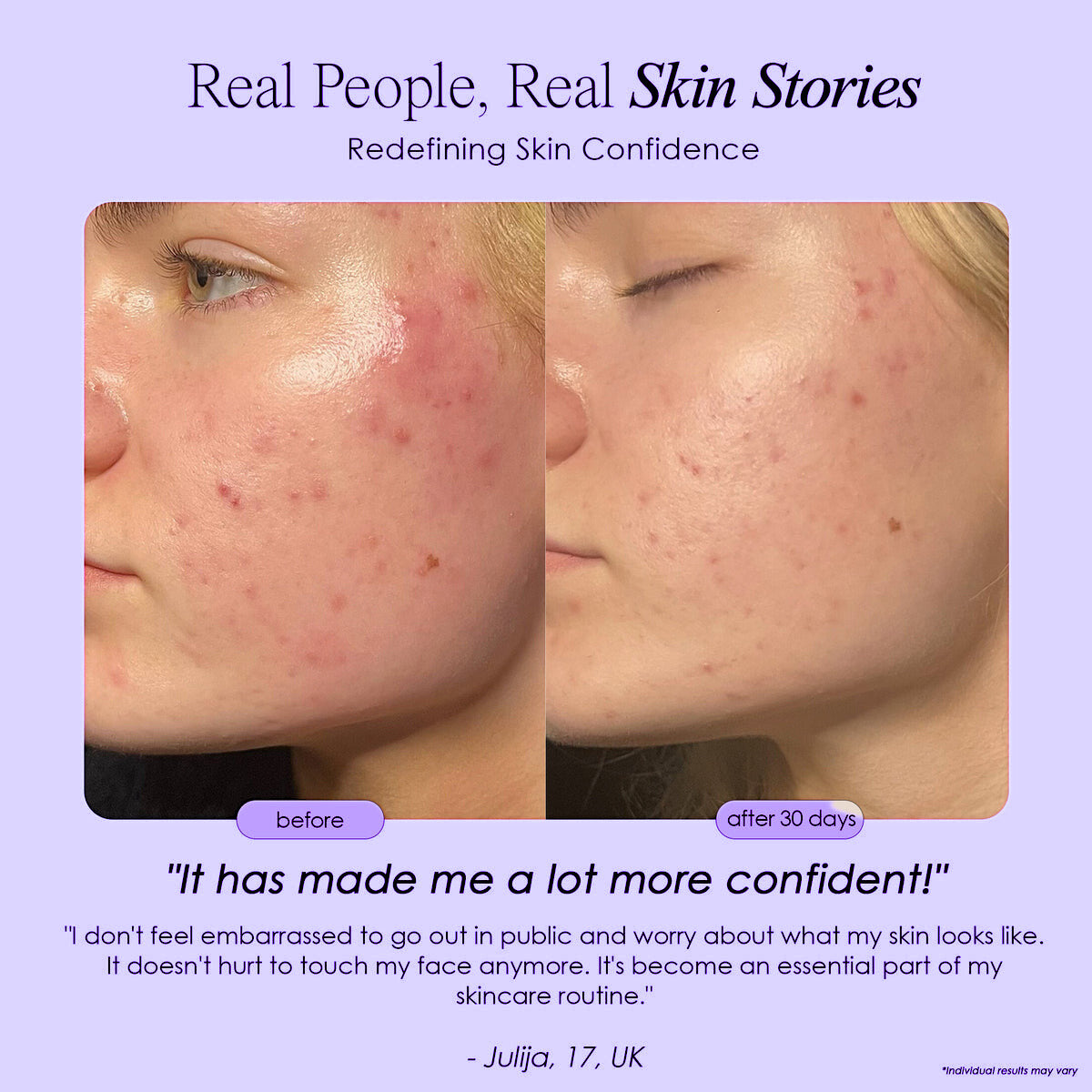 Novaskin LED Face Mask | SkynGlowUp SkynGlowUp