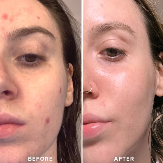 Frost Roller™ | SkynGlowUp SkynGlowUp