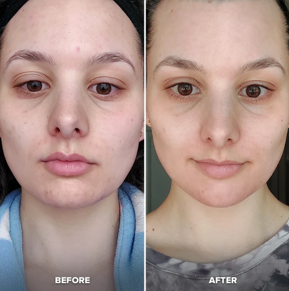 Frost Roller™ | SkynGlowUp SkynGlowUp